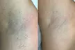 Effortless Smoothness with 3 or 6 Laser Hair-Removal Sessions on Small, Medium or Large Area (Up to 84%Off) - Second Medium