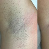 Image 3: Effortless Smoothness with 3 or 6 Laser Hair-Removal Sessions on Small, Medium or Large Area (Up to 84%Off)