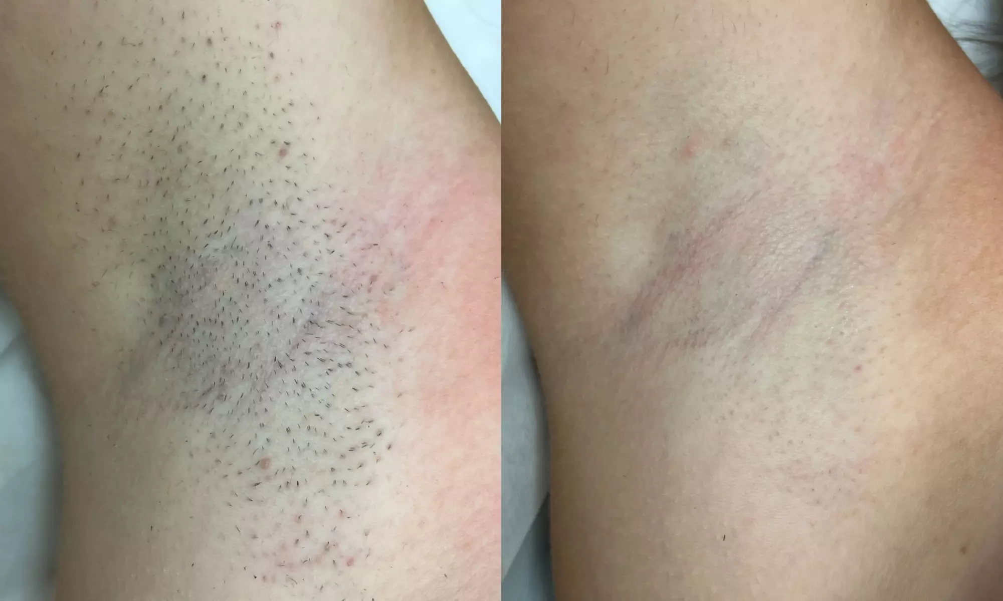 Effortless Smoothness with 3 or 6 Laser Hair-Removal Sessions on Small, Medium or Large Area (Up to 84%Off)
