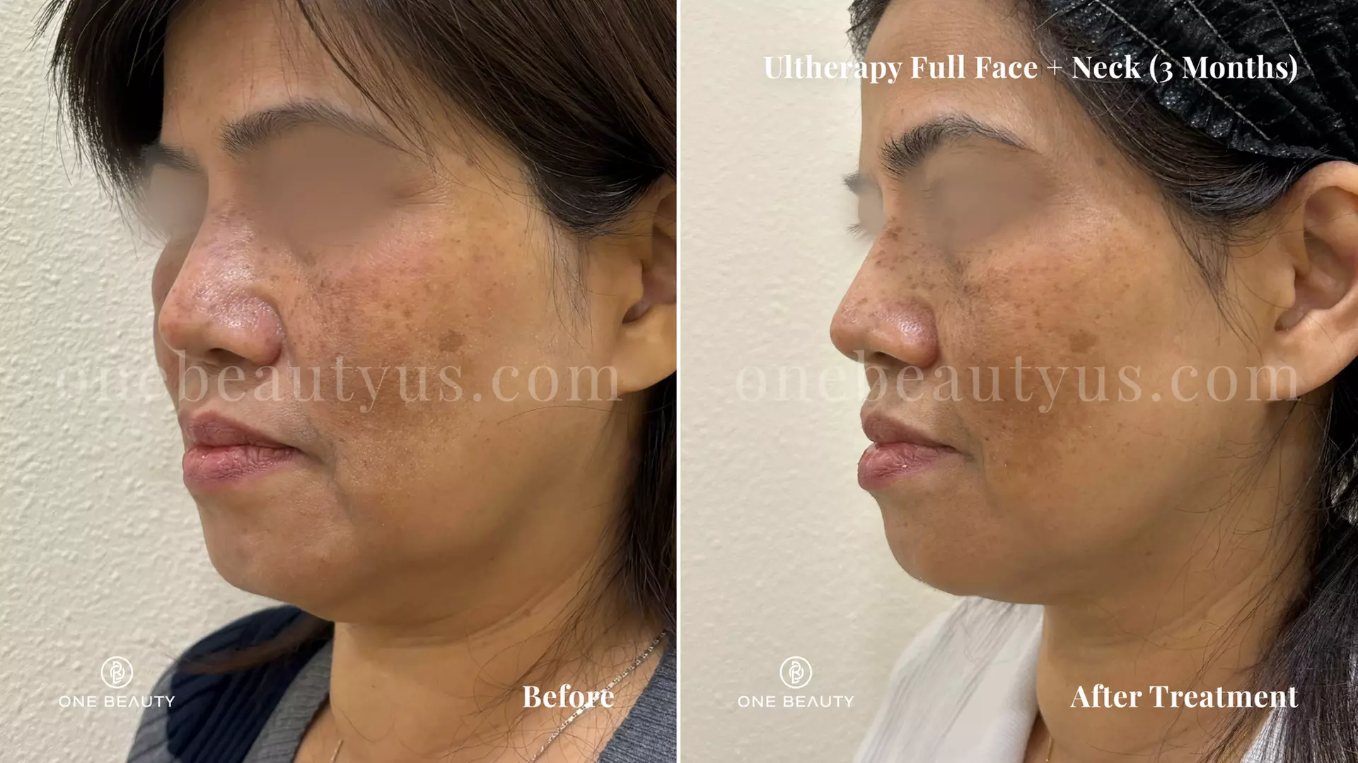 Ultherapy / Ultrasonic Facial at One Beauty Aesthetics