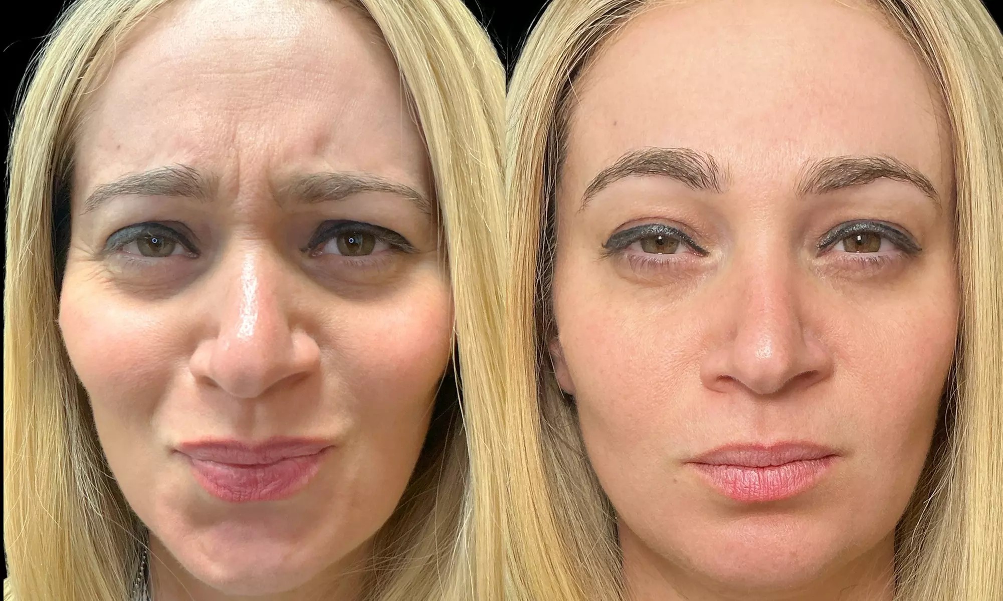 Smooth Away Lines with Botox Lip Flip, 20 or 40 Units of Botox