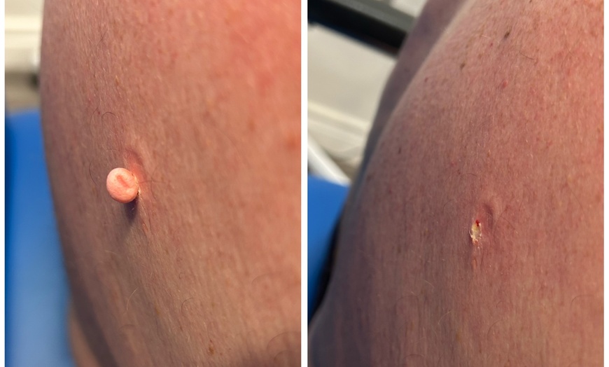 Image 3: Up to Unlimited Skin Tags, Milia, Blood Spot or Mole Wart Removal