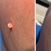 Image 3: Up to Unlimited Skin Tags, Milia, Blood Spot or Mole Wart Removal