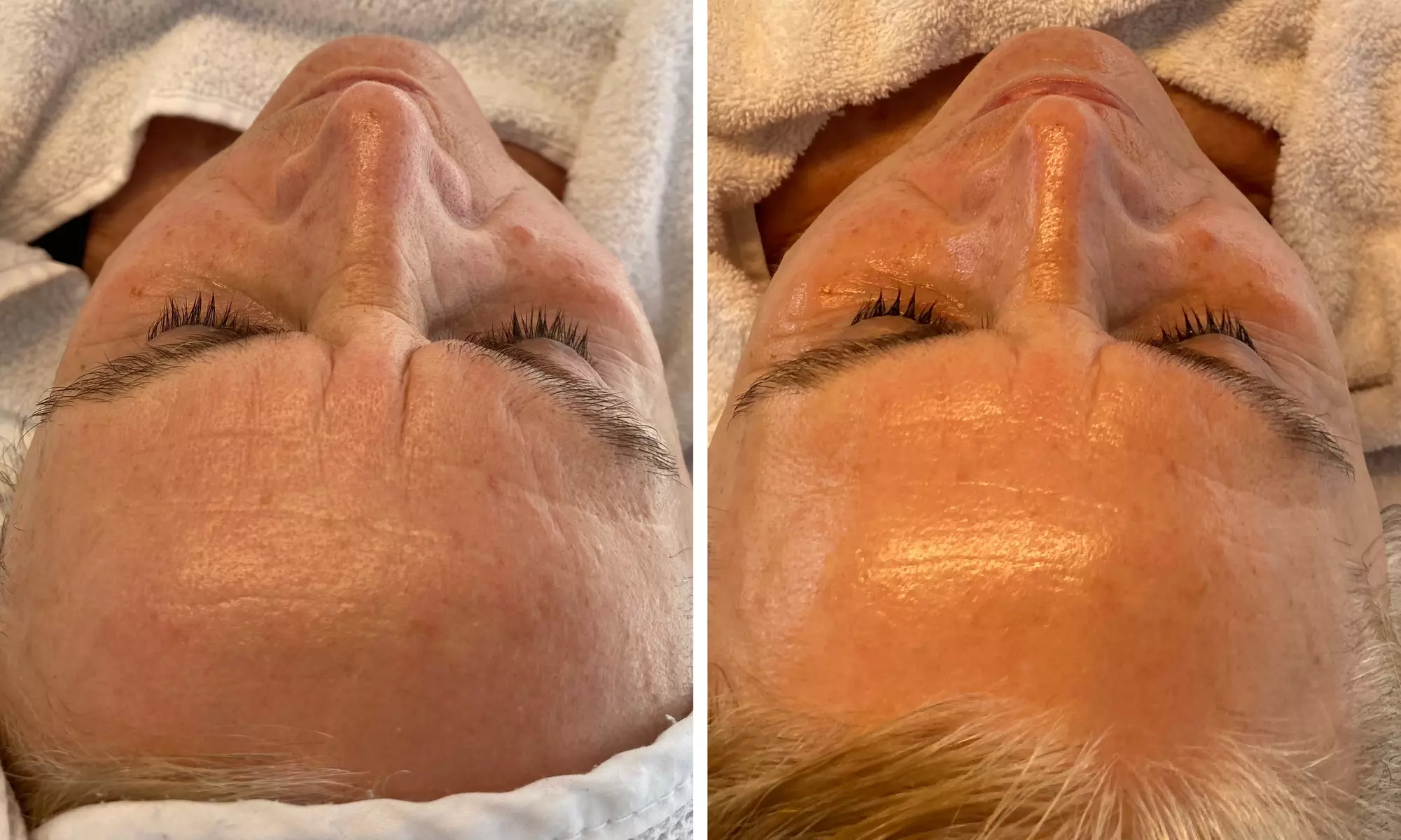 Premium Glow-Facial inkl. Wickeltherapie & MatrixxFace für 1 Person