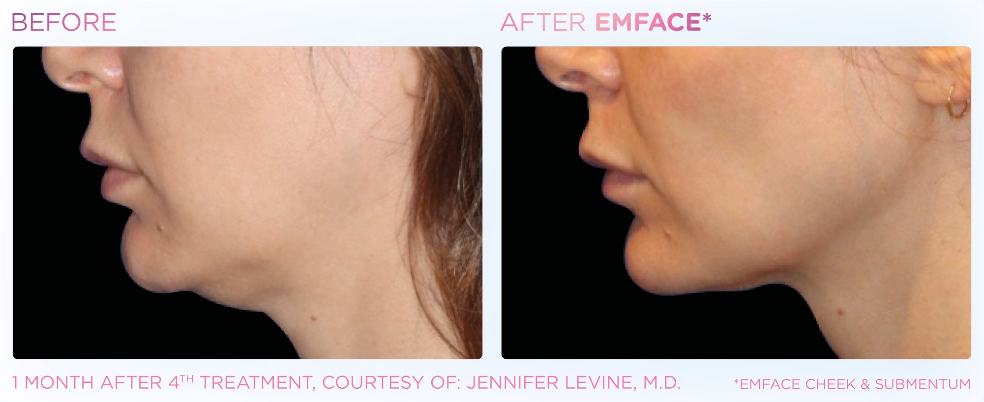Lift: Emface Non-Surgical Face Lift for Full Face (3 Areas) or 2 Areas