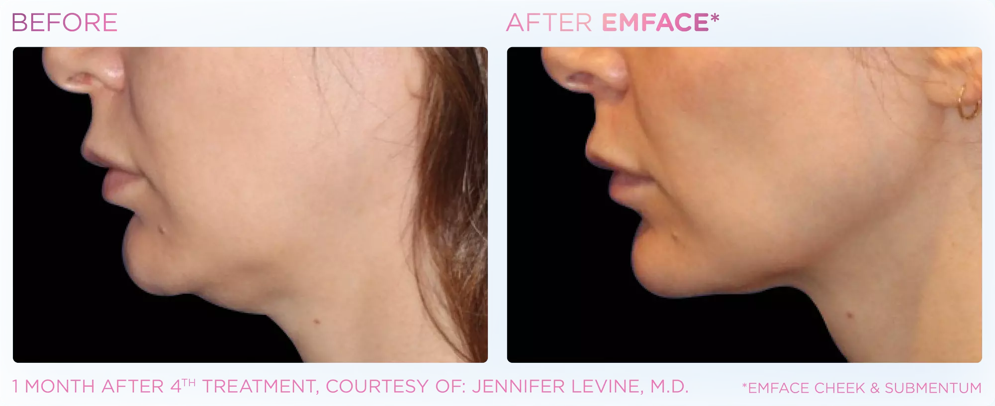 Lift & Define: Emface Non-Surgical Face Lift for Full Face (3 Areas) or 2 Areas(Up to 60% Off) at Bellissima Spa - Primary Image