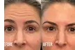 Up to 53% Off on Injection - Botox at Nude Aesthetics - Second Medium