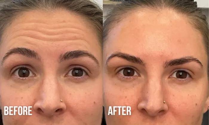 Refreshed Look with 20 or 40 Units of Botox 
