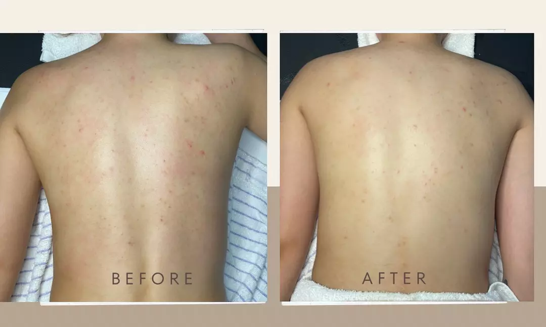 Up to 12% Off on Back Facial at Aesthetic Angels - Second Medium