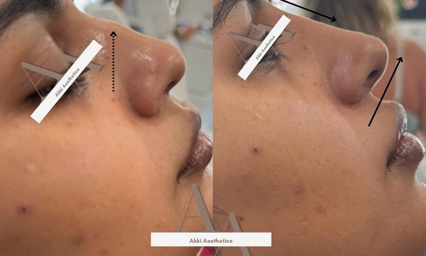 Image 3: Up to 57% Off on Injection - Dermal Filler at AK Medical Spa