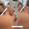 Image 3: Up to 57% Off on Injection - Dermal Filler at AK Medical Spa