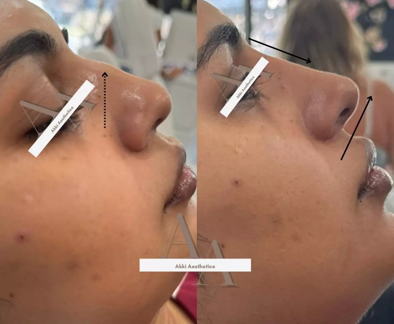 Up to 57% Off on Injection - Dermal Filler at Akki Aesthetics