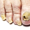 Image 1: Toenail Changes? Get an Expert Diagnosis! 
(Up to 87%)