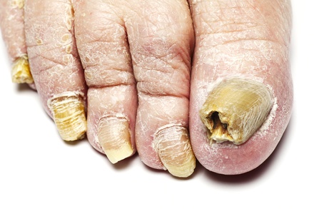 Podiatry Fungal Nail Consultation - Raymond Nash Clinic