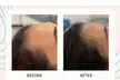 Up to 55% Off on Laser Hair Restoration at Rainier Laser and Aesthetics Center - Second Medium