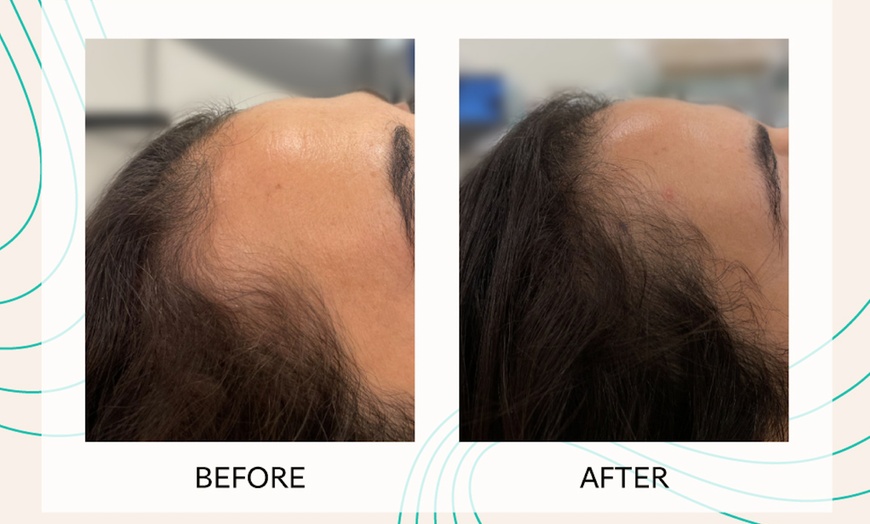 Image 5: Up to 50% Off on Laser Hair Restoration at Rainier Laser and Aesthetics Center