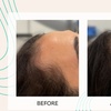 Image 5: Up to 50% Off on Laser Hair Restoration at Rainier Laser and Aesthetics Center