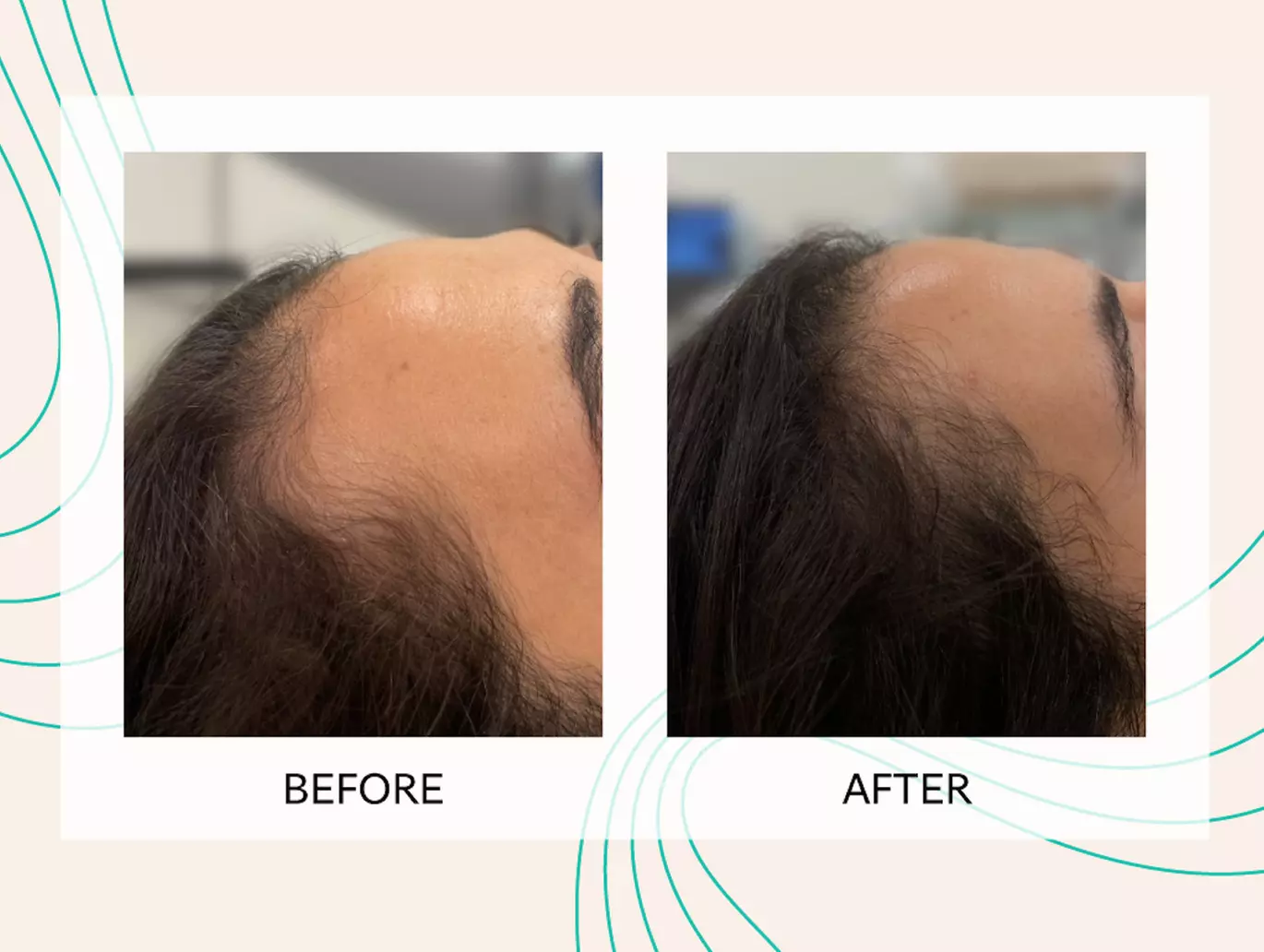 Up to 50% Off on Laser Hair Restoration at Rainier Laser and Aesthetics Center
