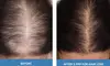 Tailored Treatments for Hairline, Half Scalp, or Full Head (Up to 37% off) at Age Management Optimal Wellness