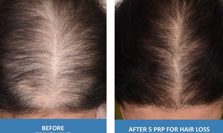 One PRP Hair Restoration Treatment for Hairline - Age Management Optimal Wellness