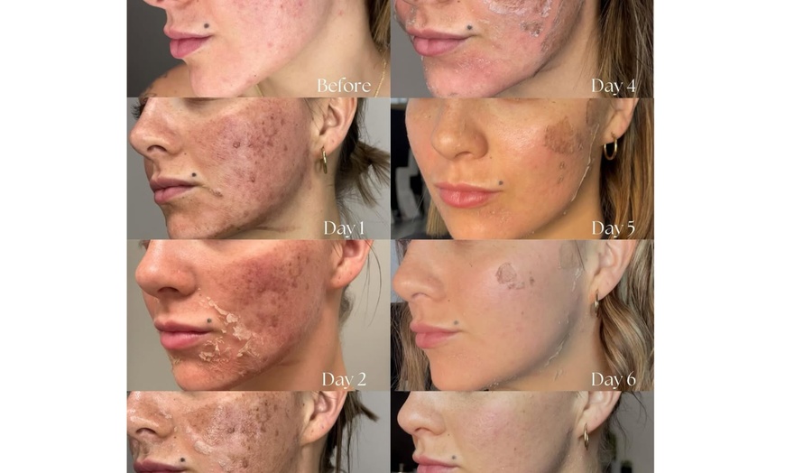 Image 2: Up to 73% Off on Facial - Chemical Peel at bc clinic