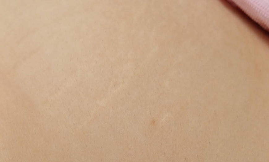 Image 4: Transform Your Skin with Targeted Stretch Mark Revision or Removal