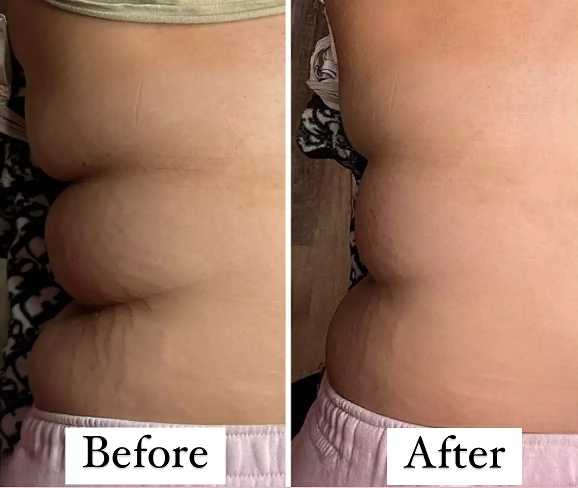 Ultrasonic Body Sculpting Sessions for a Slimmer You