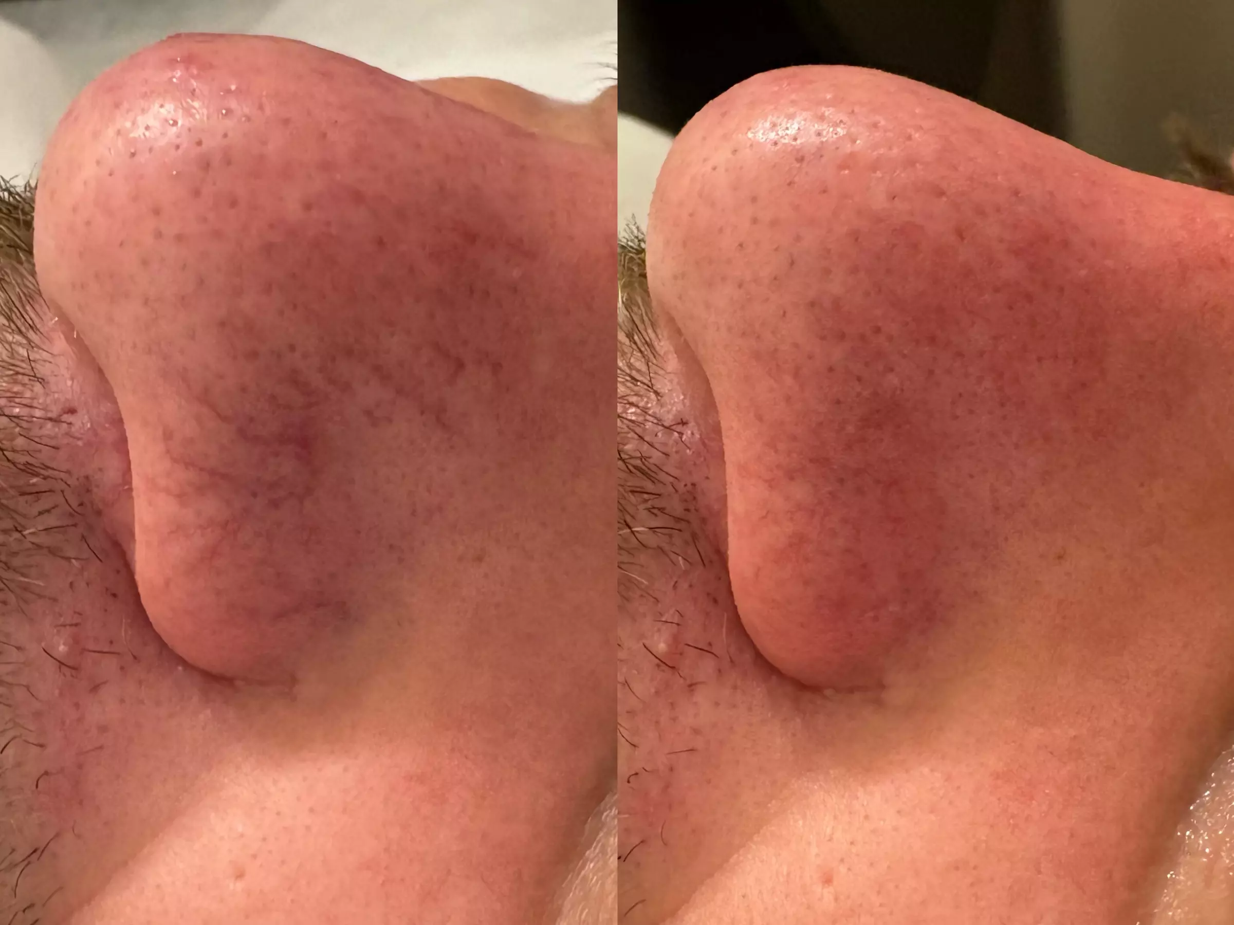 Spider Vein Laser Treatments for Nose, Face & Small Areas