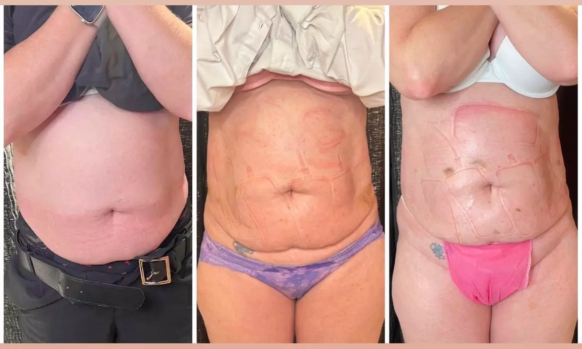 Up to 42% Off on Lipo - Non-Invasive Laser-iLipo at Extreme body sculpting
