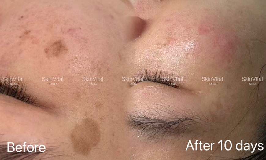 Image 1: Pico Laser Sessions for Small Targeted Areas – 1 or 3 Options 