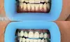 Up to 30% Off on Teeth Whitening at Lashes 2 Envy