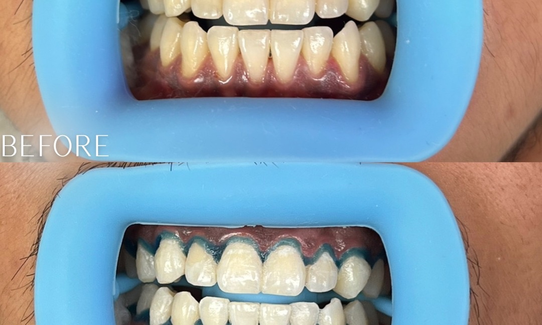 Up to 30% Off on Teeth Whitening at Lashes 2 Envy
