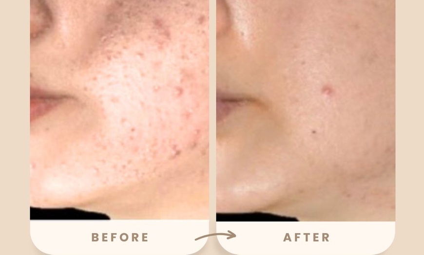 Image 6: Reverse Ageing & Repair Scars: Sylfirm X (One, Two, or Three Sessions)