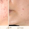 Image 6: Reverse Ageing & Repair Scars: Sylfirm X (One, Two, or Three Sessions)