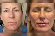 Up to 46% Off on Juvederm Injection - at PMU MD Aesthetics (Virtual Consultation Required) - Second Medium