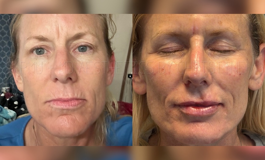 Image 1: Up to 51% Off on Injection - Juvederm Filler 