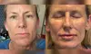 Up to 44% Off on Injection - Organic Filler at PMU + MD AESTHETICS