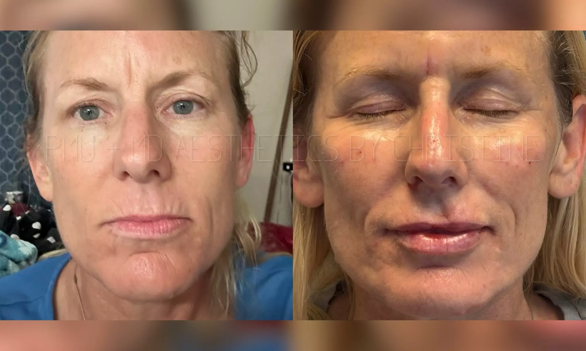 Up to 45% Off on Injection - Juvederm Filler 