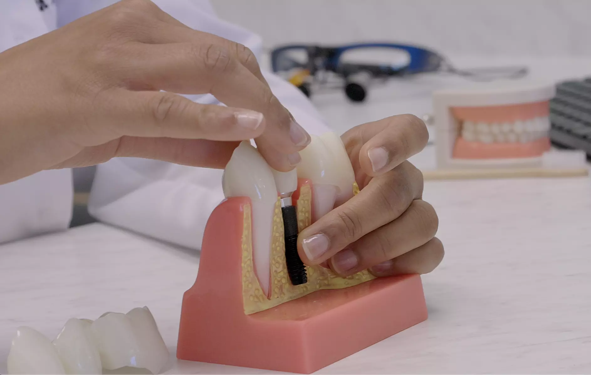 Complete Dental Implant Package – Natural-Looking Smile Restoration at Pearl Dental Studio Up To 55% Off - Primary Image