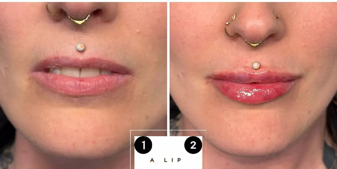 Facial Fillers from 0.5ml in Nottingham (Up to 46% Off)