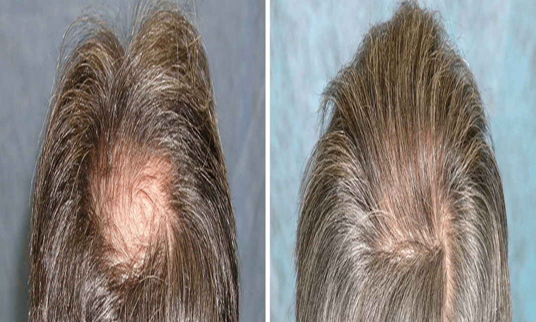 Strengthen Your Hair with Pepfactor Hair Restoration Treatment