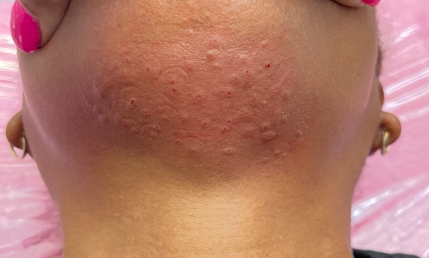 Image 2: Fat Dissolver at Pamper Me Pretty Day Spa