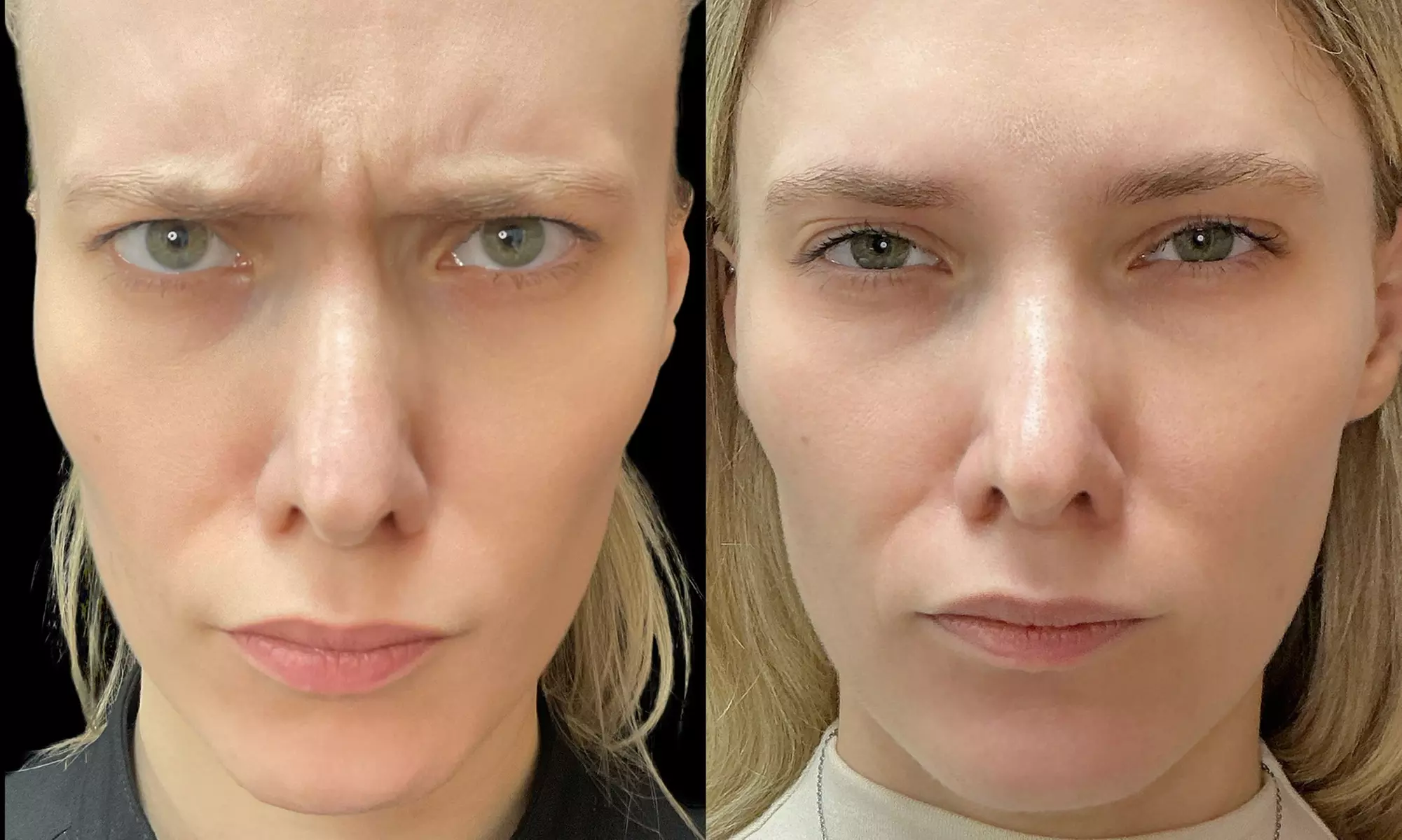 Smooth Away Lines with Botox Lip Flip, 20 or 40 Units of Botox