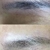 Image 2: Eyebrows Microblading & Tattoo Removal with Advanced Pico Laser