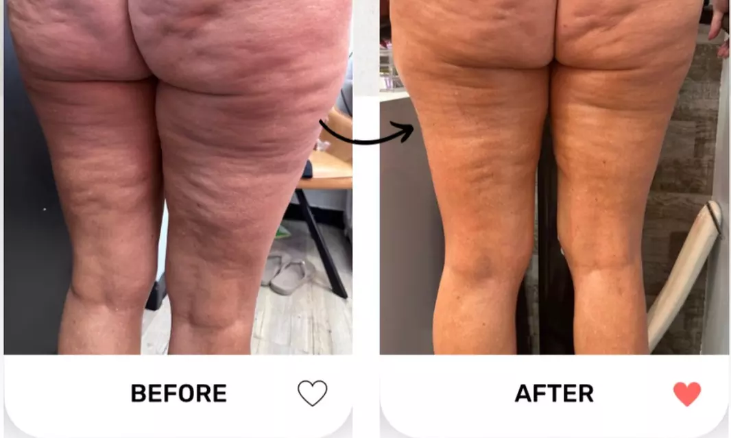 Up to 58% Off Radio Frequency Skin Tightening at The Body Lux