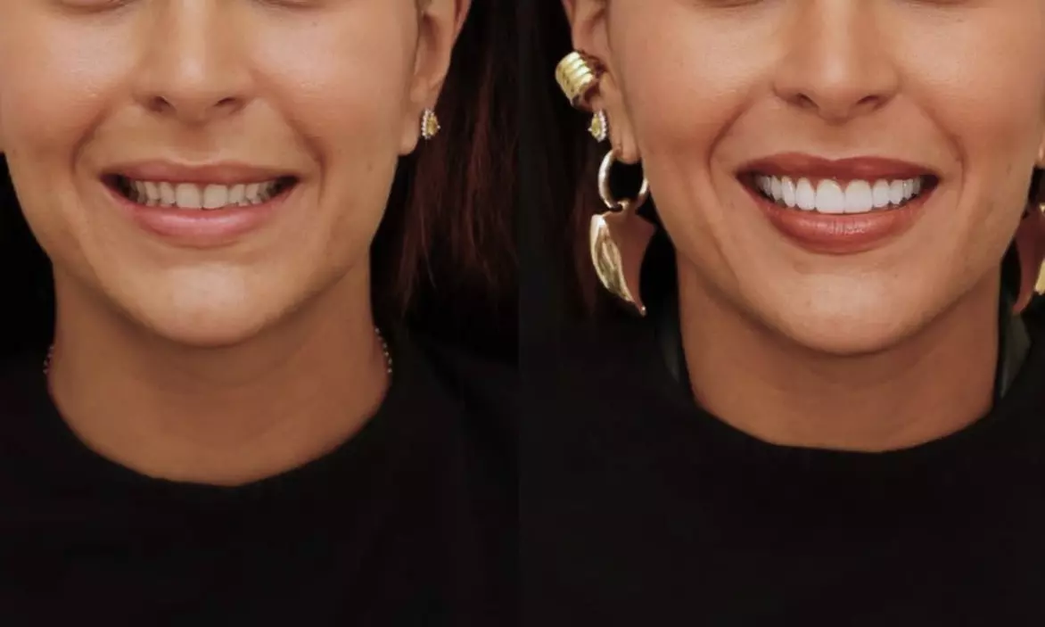 Colocación de hasta 4 carillas dentales de composite o cerámica