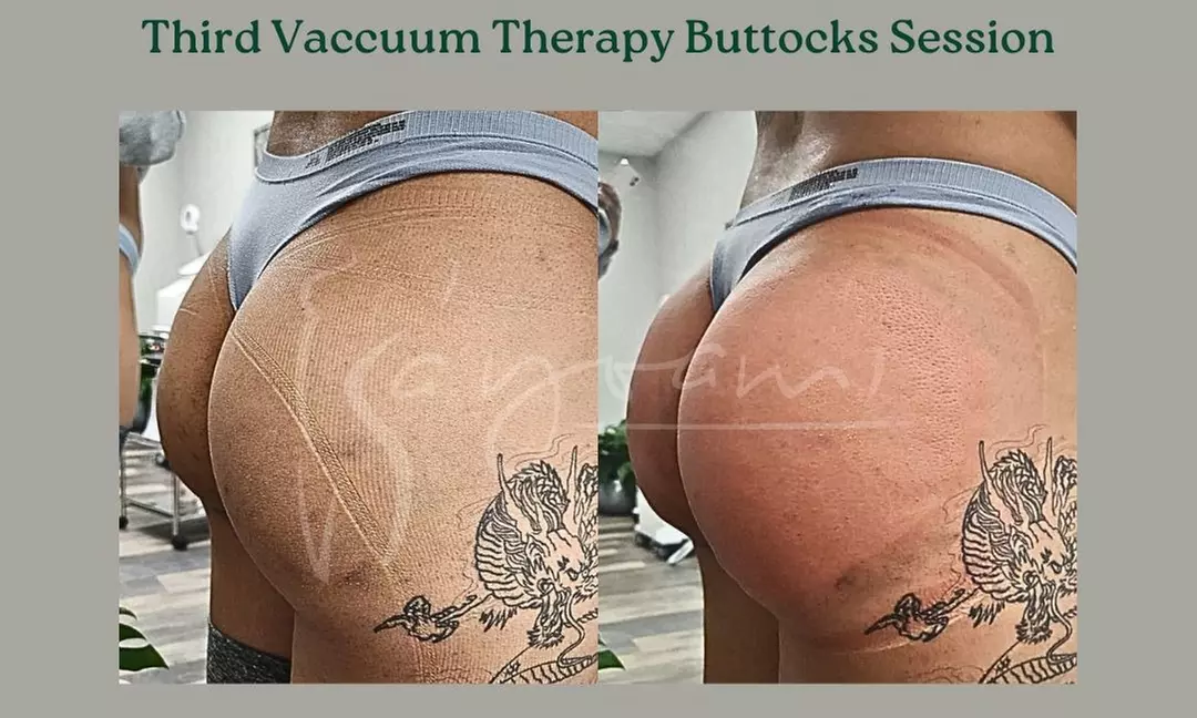 Vacuum Therapy Buttocks & Body Enhancement or CryoStatic Slimming