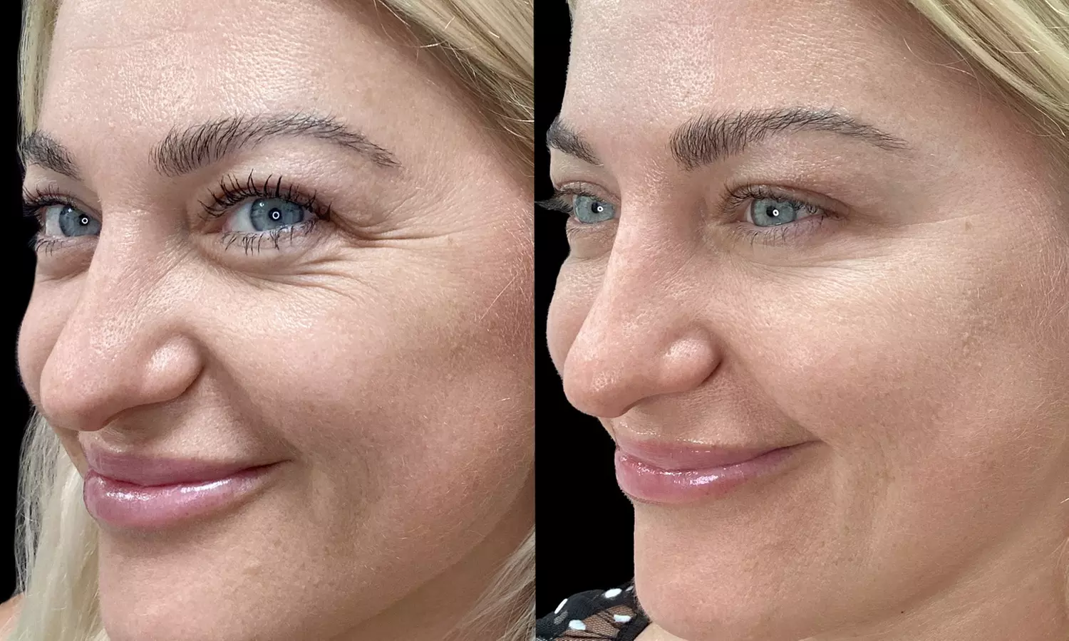Smooth Away Lines with Botox Lip Flip, 20 or 40 Units of Botox
