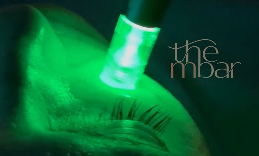 Image 2: Experience rejuvenating microneedling for face and neck