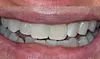 Up to 37% Off on Teeth Whitening - In-Office - Non-Branded at Moi Health and Wellness